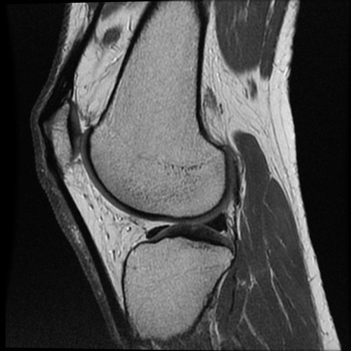 Anomalous insertion of the medial meniscus (Radiopaedia 77559-89721 Sagittal PD 20).jpg