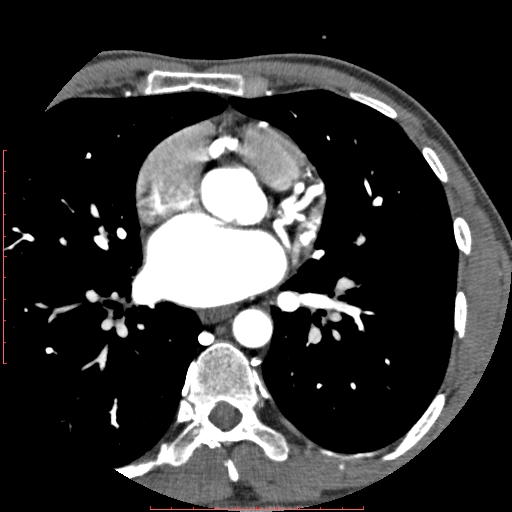 File:Anomalous left coronary artery from the pulmonary artery (ALCAPA) (Radiopaedia 70148-80181 A 123).jpg