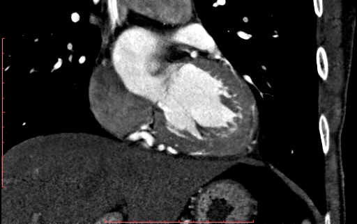 Anomalous left coronary artery from the pulmonary artery (ALCAPA) (Radiopaedia 70148-80181 B 157).jpg