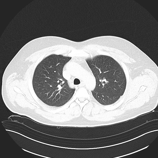 File:Anomalous origin of the left coronary artery with malignant course (Radiopaedia 77842-90126 Axial lung window 12).jpeg