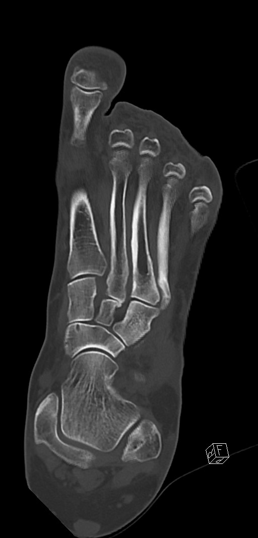 Anterior calcaneal process fracture (Radiopaedia 63353-71943 Coronal bone window 21).jpg
