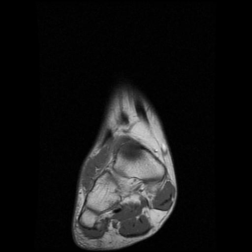 File:Anterior calcaneal process fracture (Radiopaedia 71377-81705 Coronal T1 1).jpg