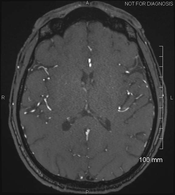 Anterior cerebral artery aneurysm (Radiopaedia 80683-94127 Axial MRA 137).jpg