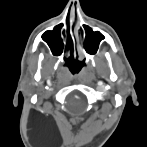 File:Anterior cerebral artery territory infarct (Radiopaedia 39327-41581 B 52).png