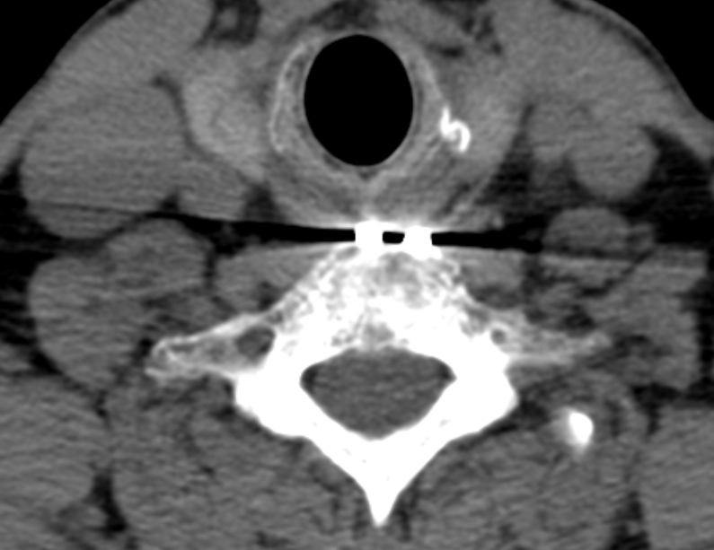 Anterior cervical postdiscectomy arthrodesis (Radiopaedia 32678-33646 Axial non-contrast 58).jpg