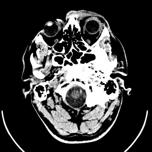 Anterior choroidal artery infarct (Radiopaedia 55106-61480 Axial non-contrast 1).jpg