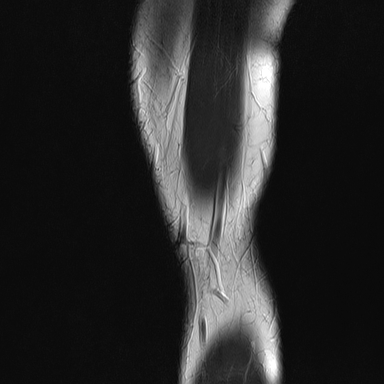 File:Anterior cruciate ligament full thickness tear (Radiopaedia 66268-75467 Sagittal T2 1).jpg