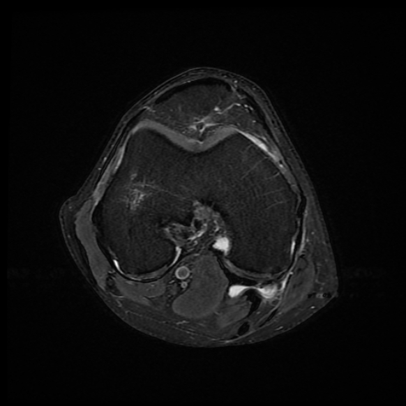 File:Anterior cruciate ligament graft tear and bucket-handle tear of medial meniscus (Radiopaedia 75867-87254 Axial PD fat sat 15).jpg