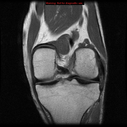 File:Anterior cruciate ligament injury - partial thickness tear (Radiopaedia 12176-12515 D 7).jpg