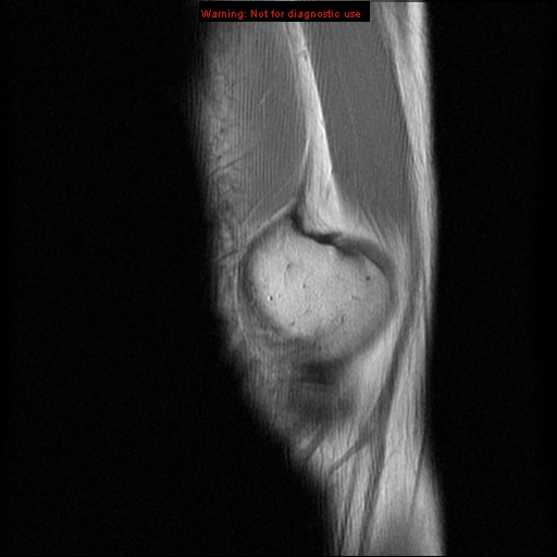 File:Anterior cruciate ligament injury - partial thickness tear (Radiopaedia 12176-12515 Sagittal PD 2).jpg