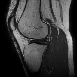 Anterior cruciate ligament rupture and posteromedial corner injury (Radiopaedia 67338-76723 Sagittal PD 110).jpg