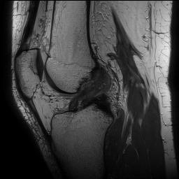 Anterior cruciate ligament rupture with Segond fracture (Radiopaedia 69043-78806 Sagittal PD 100).jpg