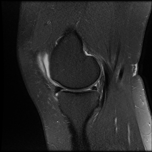 File:Anterior cruciate ligament tear, Wrisberg rip and bucket-handle tear of medial meniscus (Radiopaedia 75872-87266 Sagittal PD fat sat 19).jpg