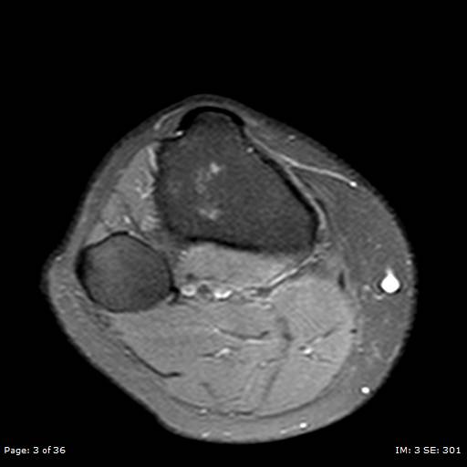 File:Anterior cruciate ligament tear (Radiopaedia 70783-80964 Axial PD fat sat 3).jpg