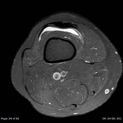 File:Anterior cruciate ligament tear (Radiopaedia 70783-80964 Axial PD fat sat 34).jpg