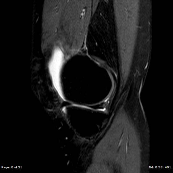 File:Anterior cruciate ligament tear (Radiopaedia 70783-80964 Sagittal STIR 8).jpg