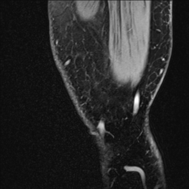 Anterior cruciate ligament tear - ramp lesion (Radiopaedia 71883-82322 Sagittal T1 vibe 140).jpg