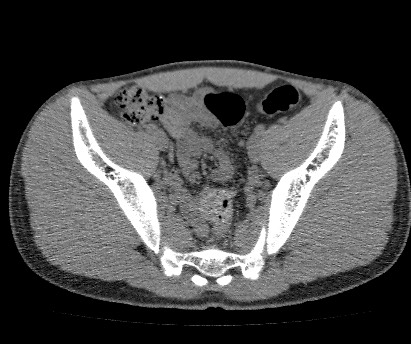 Anterior inferior iliac spine avulsion fracture (Radiopaedia 81312-94999 Axial non-contrast 37).jpg