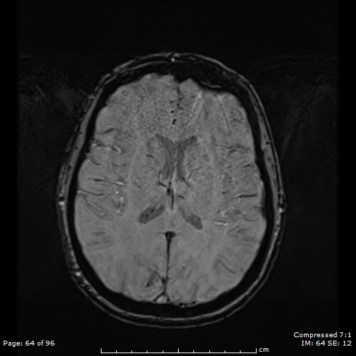 Anterior temporal lobe perivascular space (Radiopaedia 88283-104914 Axial SWI 33).jpg