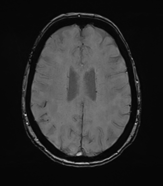 Anterior temporal pole cysts (Radiopaedia 46629-51102 Axial SWI 58).png