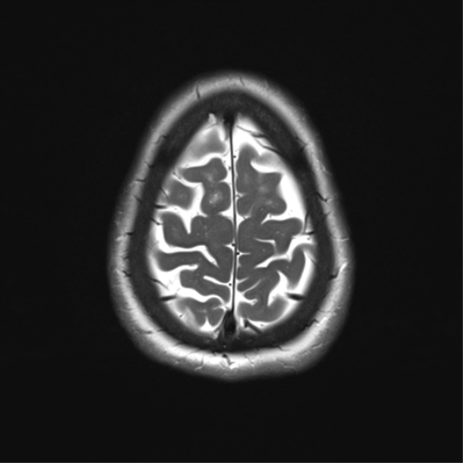 File:Anterior temporal pole cysts (Radiopaedia 46629-51102 C 33).png
