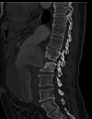 File:Anterior vertebral scalloping (abdominal aortic aneurysm) (Radiopaedia 66744-76067 Sagittal bone window 46).jpg