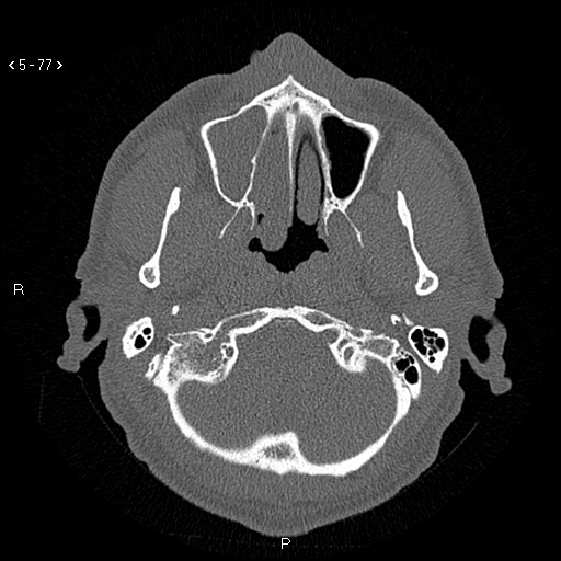 Antrochoanal Polyp (Radiopaedia 70510-80631 Axial bone window 25).jpg