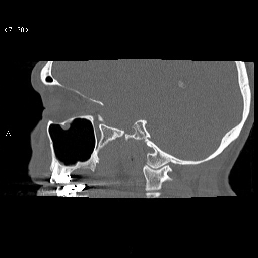 File:Antrochoanal Polyp (Radiopaedia 70510-80631 Sagittal bone window 20).jpg