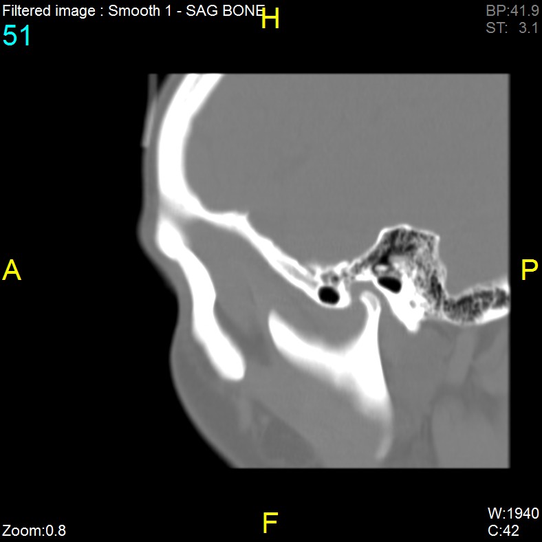 Antrochoanal polyp (Radiopaedia 65101-74094 Sagittal bone window 51).jpg