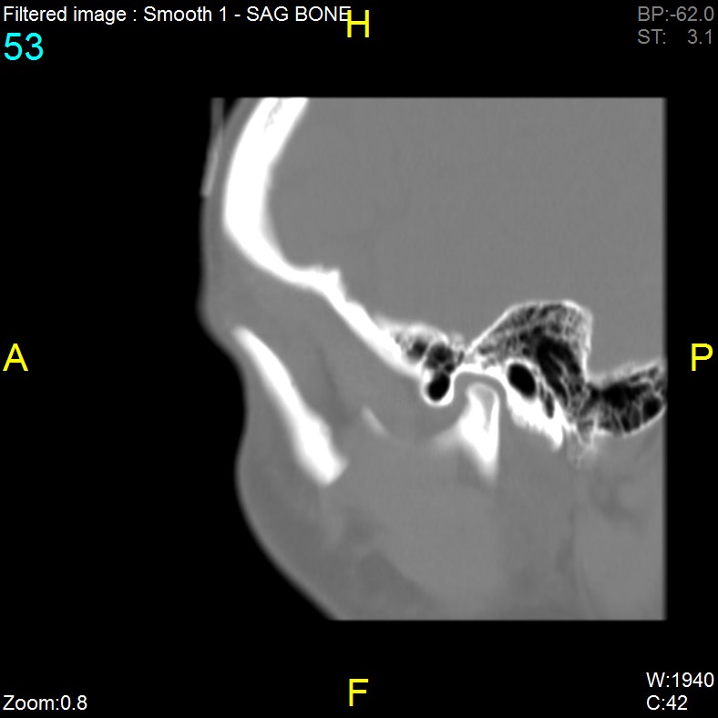 Antrochoanal polyp (Radiopaedia 65101-74094 Sagittal bone window 53).jpg
