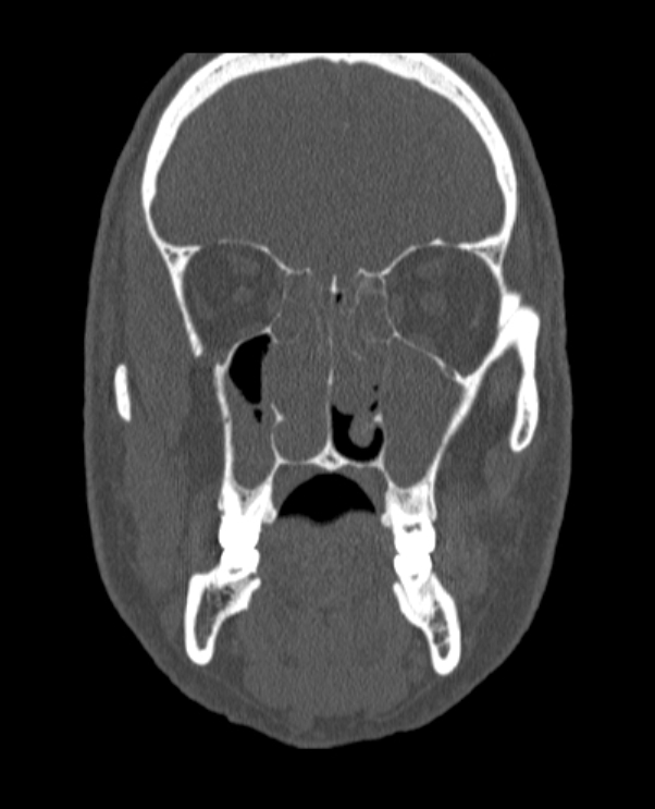 Antrochoanal polyp (Radiopaedia 79011-92169 Coronal bone window 46).jpg