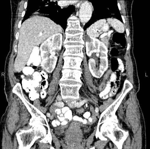 Aortic aneurysm and Lemmel syndrome (Radiopaedia 86499-102554 C 38).jpg