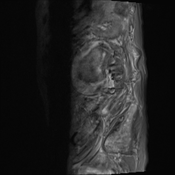 File:Aortic aneurysm with spinal destruction (Radiopaedia 42301-45409 Sagittal T1 fat sat 37).jpg