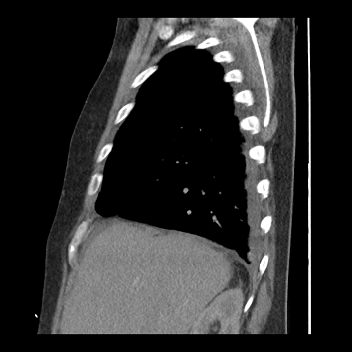 Aortic arch graft infection (FDG PET-CT) (Radiopaedia 71975-82437 C 14).jpg