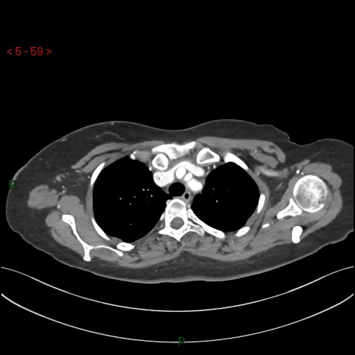 File:Aortic arch origin of left vertebral artery (Radiopaedia 51520-57286 A 58).jpg