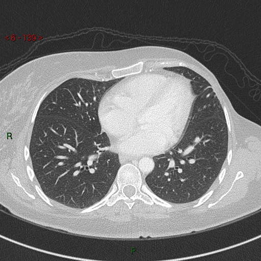 Aortic arch origin of left vertebral artery (Radiopaedia 51520-57286 Axial lung window 139).jpg