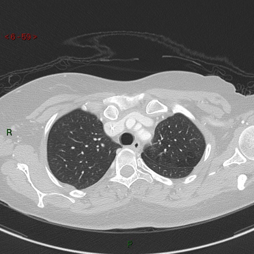 Aortic arch origin of left vertebral artery (Radiopaedia 51520-57286 Axial lung window 59).jpg
