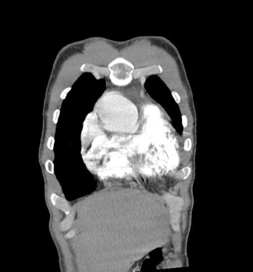 Aortic coarctation with aneurysm (Radiopaedia 74818-85828 C 18).jpg