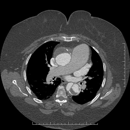 File:Aortic dissection- Stanford A (Radiopaedia 35729-37268 A 42).jpg