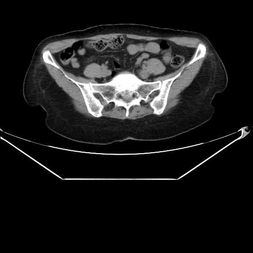 Aortic dissection (Radiopaedia 25350-25604 B 61).jpg