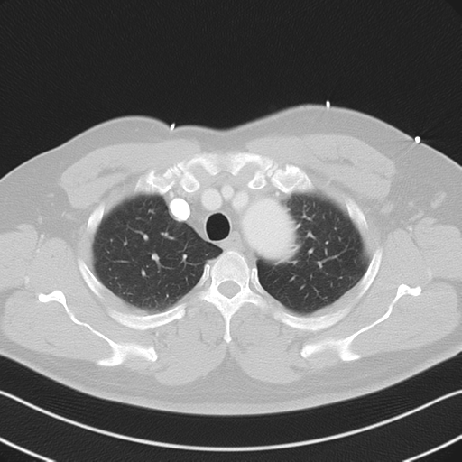 File:Aortic dissection (Radiopaedia 50763-56234 Axial lung window 18).png