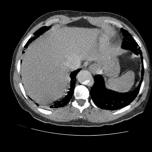 File:Aortic dissection - Stanford A -DeBakey I (Radiopaedia 28339-28587 B 86).jpg