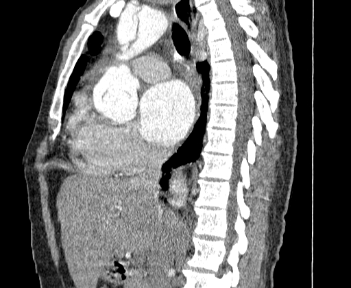 File:Aortic dissection - Stanford A -DeBakey I (Radiopaedia 28339-28587 C 22).jpg