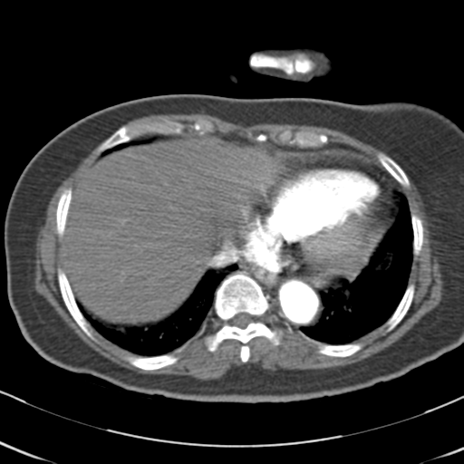 File:Aortic dissection - Stanford type A (Radiopaedia 39073-41259 A 61).png