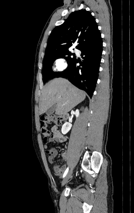 Aortic dissection - Stanford type A (Radiopaedia 83418-98500 B 4).jpg