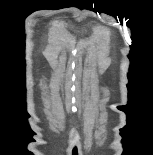 File:Aortic dissection - Stanford type B (Radiopaedia 50171-55512 B 83).png