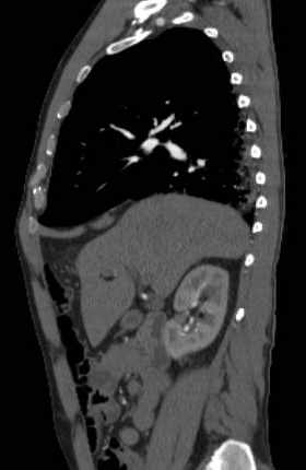 File:Aortic dissection - Stanford type B (Radiopaedia 73648-84437 C 106).jpg