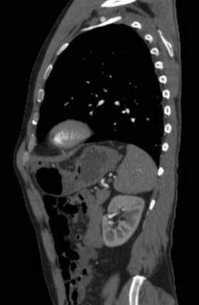 File:Aortic dissection - Stanford type B (Radiopaedia 73648-84437 C 39).jpg