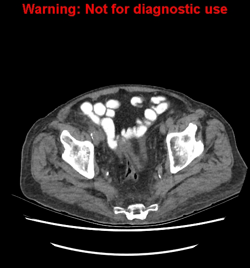 Aortic graft infection (Radiopaedia 44979-48907 Axial non-contrast 82).jpg