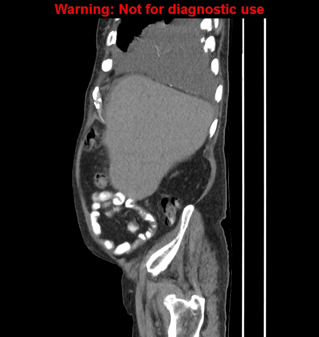 Aortic graft infection (Radiopaedia 44979-48907 C 56).jpg